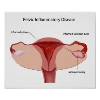 Pelvic inflammatory disease Poster