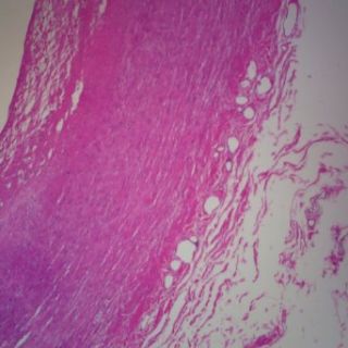Human Atherosclerosis   Artery, sec. 7 µm H&E Microscope Slide